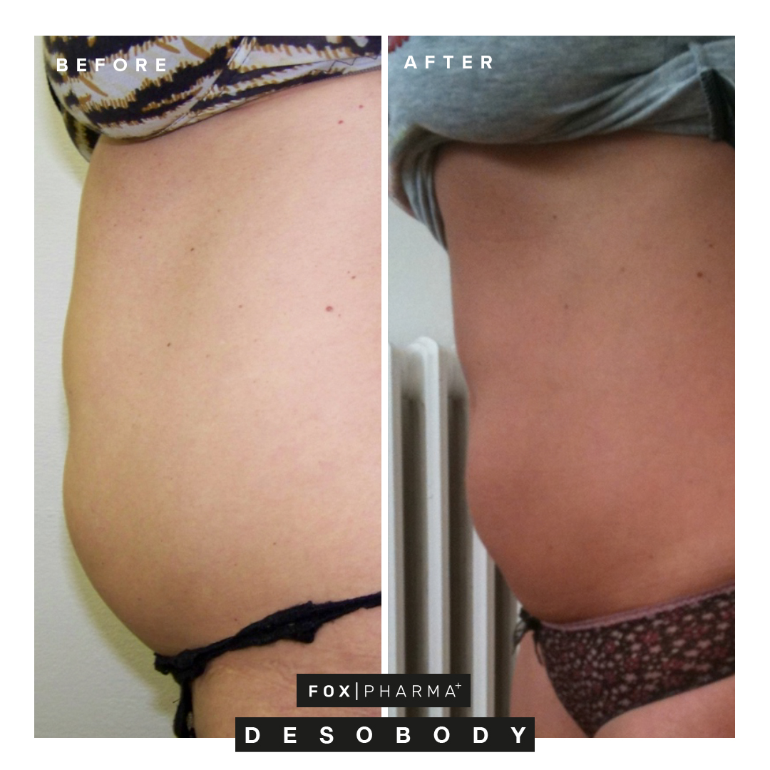 Before and after non-surgical tummy tuck
