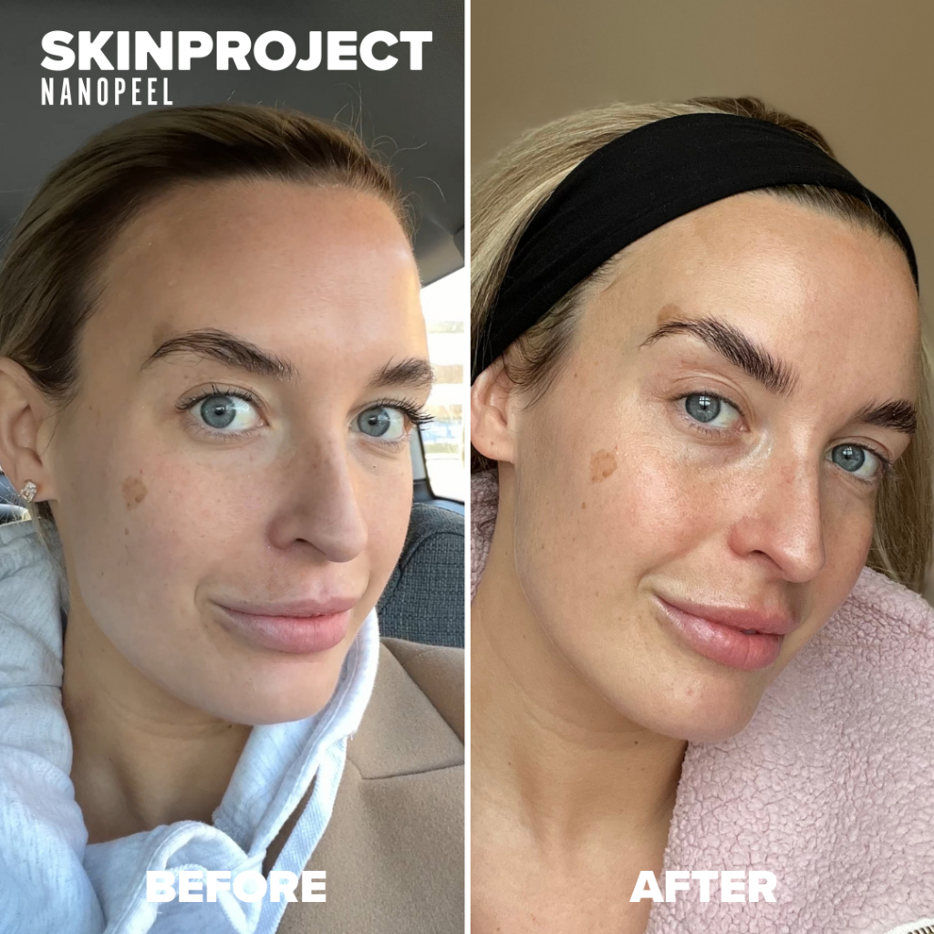 SKINPROJECT JESSNER before and after results